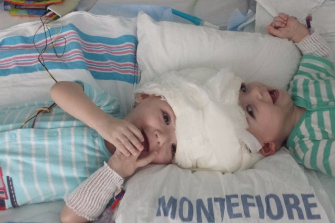 Общество: В Нью-Йорке успешно прошла операция по разделению сиамских близнецов