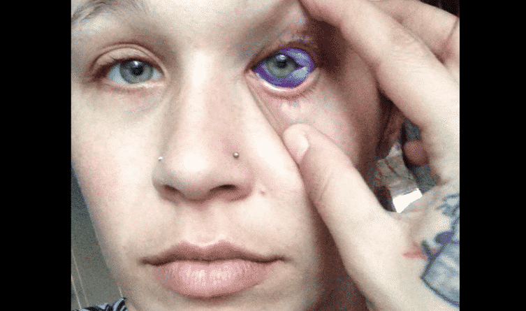 Общество: Жительница Канады столкнулась с ужасными последствиями татуировки на глазу