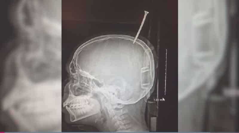 Происшествия: Мальчик выжил после травмирования черепа огромным винтом