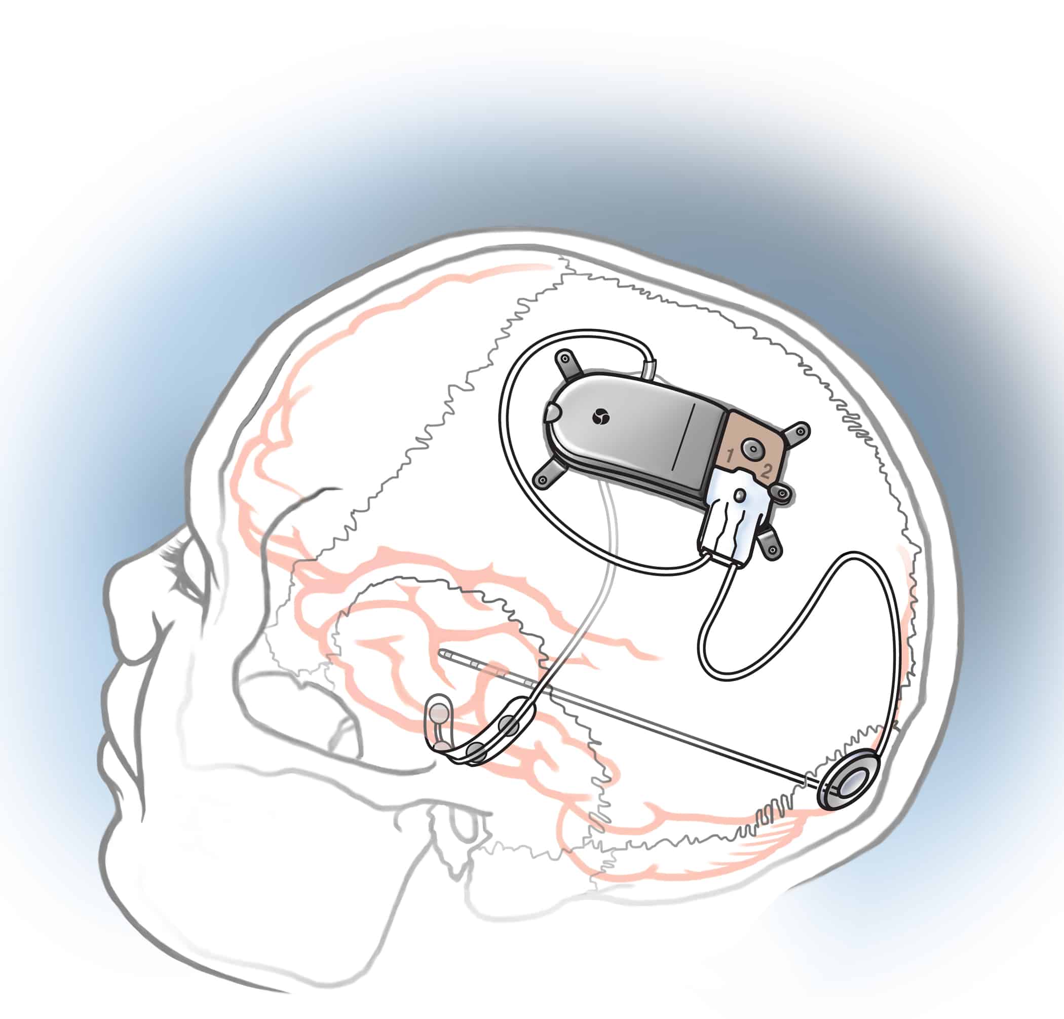 Наука: Фантастика наяву: имплантируемое в мозг устройство сможет останавливать приступы эпилепсии