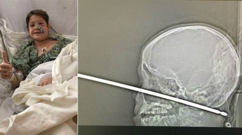 Здоровье: Медицинское чудо: 10-летний ребенок выжил, упав лицом на вертел (фото)