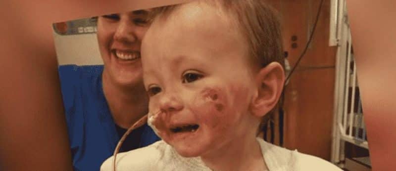 Здоровье: 2-летнему малышу ампутировали конечности из-за молниеносной пурпуры