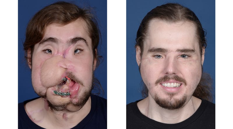 Здоровье: Парень, выстреливший в себя, показал новое лицо после трансплантации (фото)