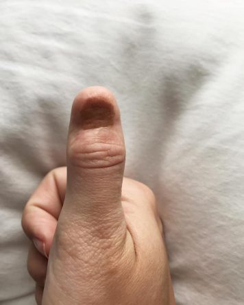 Здоровье: палец без ногтя