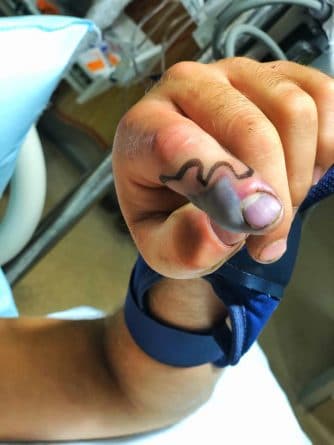 Здоровье: У жителя Теннесси, который проигнорировал укус гремучей змеи, палец раздулся до размеров лимона