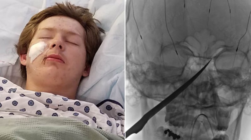 Здоровье: Чудесное спасение: подросток вонзил в череп 25-сантиметровый нож и выжил (фото)