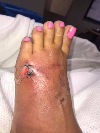 Здоровье: фотография раны на ноге Линн после операции