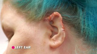 Здоровье: Женщине из Филадельфии удалили огромные келоидные наросты на ушах после пирсинга рис 4