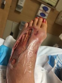 Здоровье: Жительница Огайо не заходила в воду — но заразилась плотоядной бактерией, «прогрызшей» ей ногу до кости