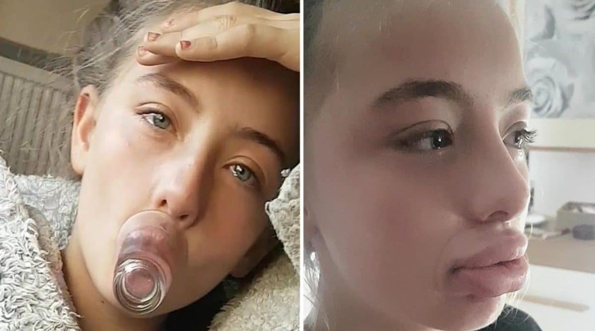 Kylie jenner lip challenge fails