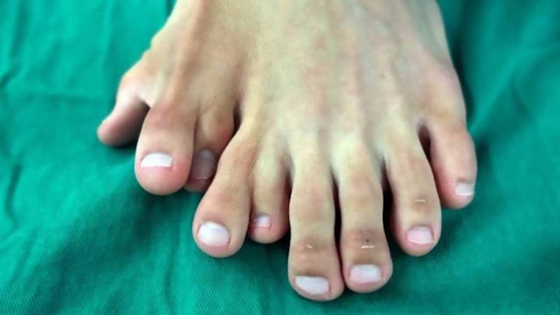Здоровье: Китайцу, который прожил 21 год с 9 пальцами на левой ноге, врачи наконец удалили 4 лишних