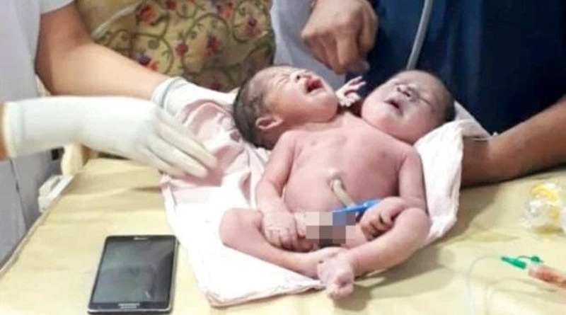 Здоровье: Женщина потеряла сознание от шока, когда родила ребенка с двумя головами и тремя руками (видео)