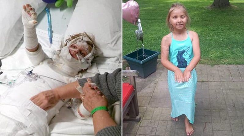 Здоровье: Девочка 5 лет «изменилась до неузнаваемости» из-за вспыхнувшей свечи, с которой она играла