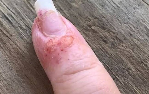 фото пальца женщина после процедуры