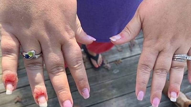 фотография пальцев женщины после процедуры