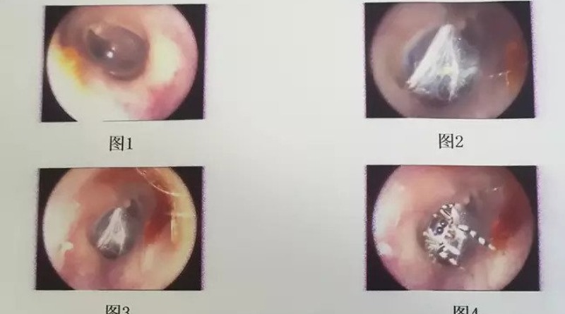 Здоровье: Женщина обратилась к медикам с жалобами на боль в ухе: оказалось, в слуховом канале неделю жил паук