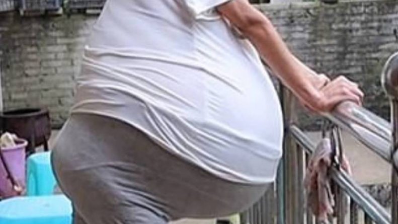 Здоровье: Живот женщины вздулся как огромный шар по непонятной причине. Он весит уже 44 фунта