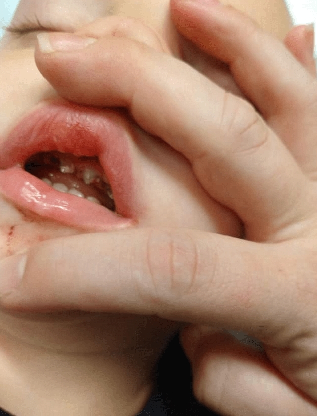 фотография зубов ребенка после операции
