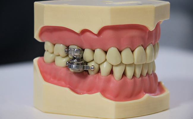 Здоровье: Новое устройство для похудания, ставящее замок на зубы, назвали «механизмом для пыток»